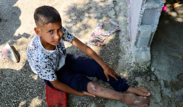 Kaza sonrası ayağı yanlış kaynadı, hayatı kaykay üzerinde geçiyor